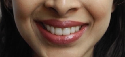 Womans smile after dental work