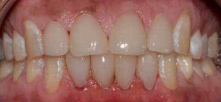 Teeth after dental work