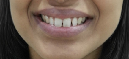 Womans smile before dental work