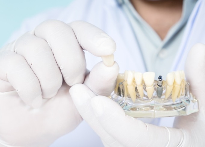 Dentist holding model of mouth with dental implant in Glastonbury