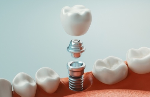 Dental implant and crown being placed in mouth