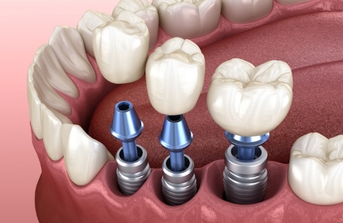 Three dental implants in a row being placed in jaw