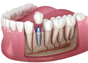 Rendering of a single dental implant with crown over it with white background