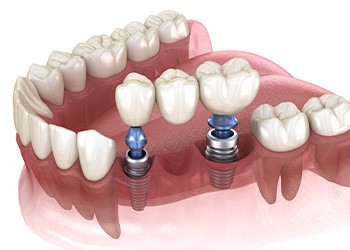 Rendering of implant bridge in a lower jaw that’s pink and transparent with white background