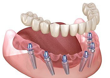 Rendering of a lower set of implant dentures with 6 titanium rods