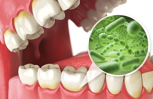 Plaque and bacteria gathering near the gumline