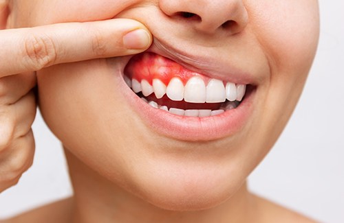 A woman revealing her red and inflamed gums