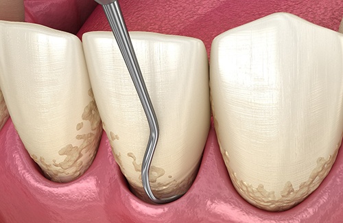 A 3D illustration of a scaling and root planing treatment