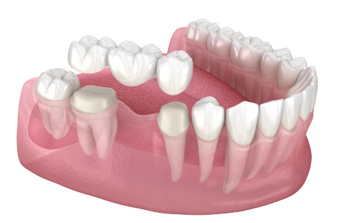 Dental implant and crown being placed in mouth