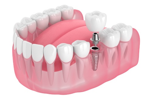 Dental implant and crown being placed in mouth