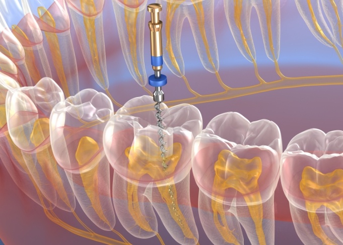 Illustration of tooth receiving root canal treatment in Glastonbury